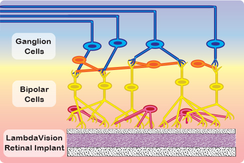 LambdaVision's innovative artificial retina for those afflicted with retinal degenerative diseases.